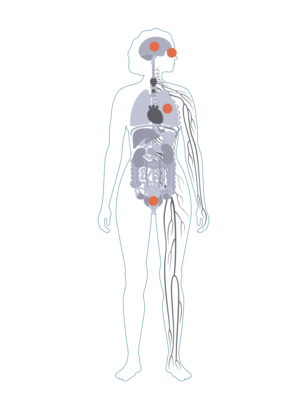 Diagram of a body with acute complications of sickle cell disease affecting the brain, eyes, lungs, and more