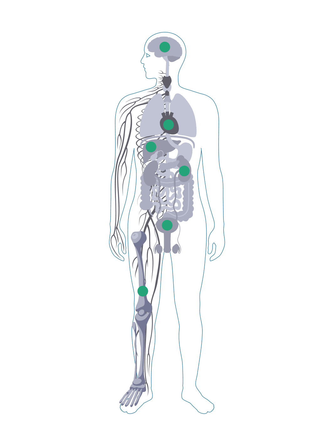 Diagram of a body with chronic complications of sickle cell disease affecting the brain, heart, liver, kidney, and more